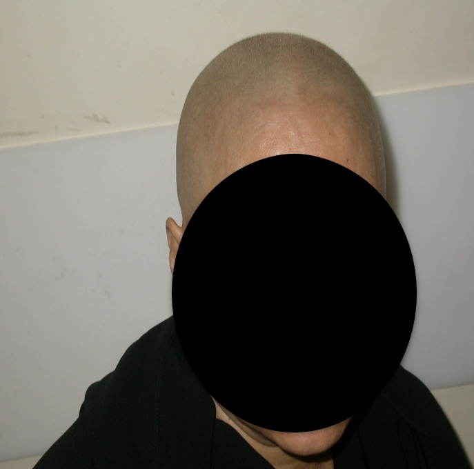 Read more about the article A  CASE OF ALOPECIA TOTALIS
