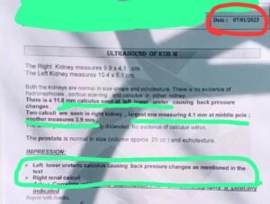Read more about the article A CASE OF RECURRENT RENAL CALCULI