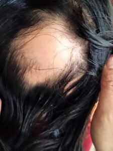 Read more about the article A CASE OF ALOPECIA CAPITIS