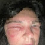 Case of Pemphigus Vulgaris with Post Herpectic Neuralgic pain