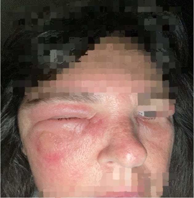 You are currently viewing Case of Pemphigus Vulgaris with Post Herpectic Neuralgic pain