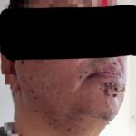 Case of Multiple Warts on face