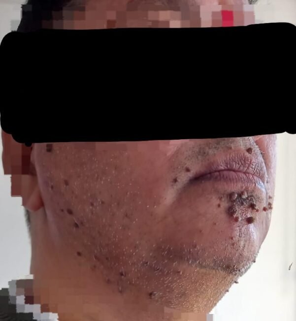 You are currently viewing Case of Multiple Warts on face