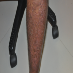 CASE OF PSORIASIS