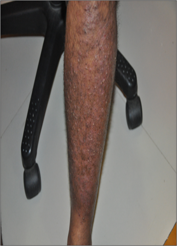 You are currently viewing CASE OF PSORIASIS