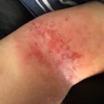 CASE OF ECZEMA IN 1-YEAR-OLD CHILD