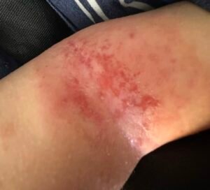 Read more about the article CASE OF ECZEMA IN 1-YEAR-OLD CHILD